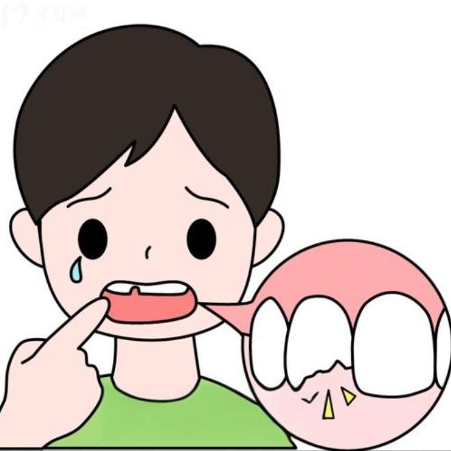乳牙磕斷了一半怎么辦？直接拔掉還是修復？