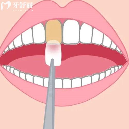 2025北京牙齒貼面的價格是多少?快看北京牙齒貼面不同品牌收費標(biāo)準(zhǔn)不貴