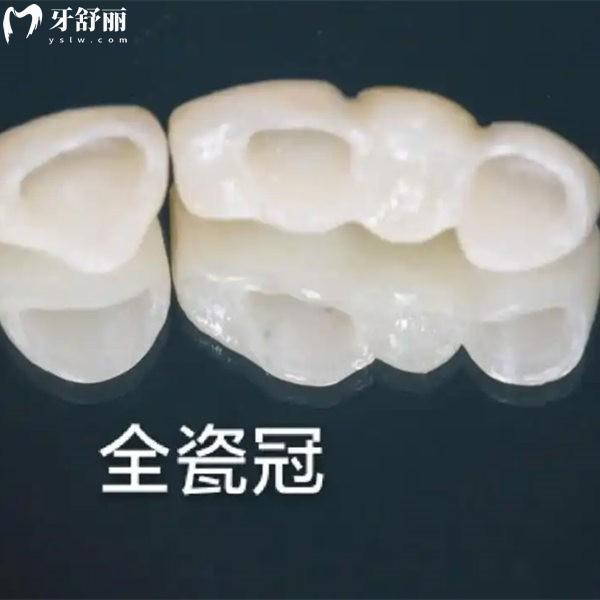 2025安一個(gè)假牙多少錢?裝活動(dòng)假牙/全瓷牙/種植牙單顆半口全口價(jià)格解析