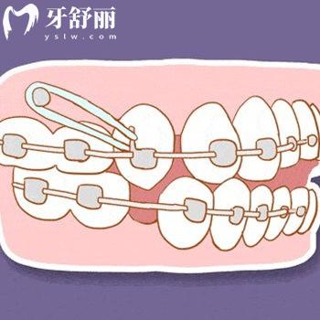 2025沈陽口腔牙科矯正牙齒收費(fèi)標(biāo)準(zhǔn):金屬矯正6000+自鎖8K+隱形2W+半隱形1W+