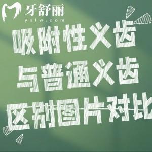 吸附性義齒與普通義齒區(qū)別圖片對比:固定方式/舒適度/使用壽命/價格差一覽可知
