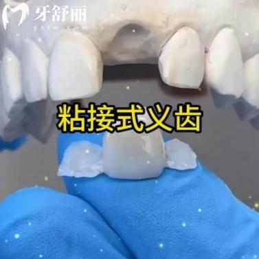 粘接橋修復(fù)優(yōu)缺點(diǎn)分析：不磨牙的補(bǔ)牙法，真香還是踩坑？